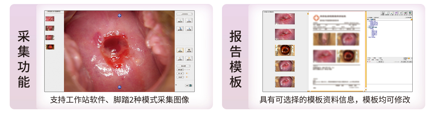 数码电子阴道镜