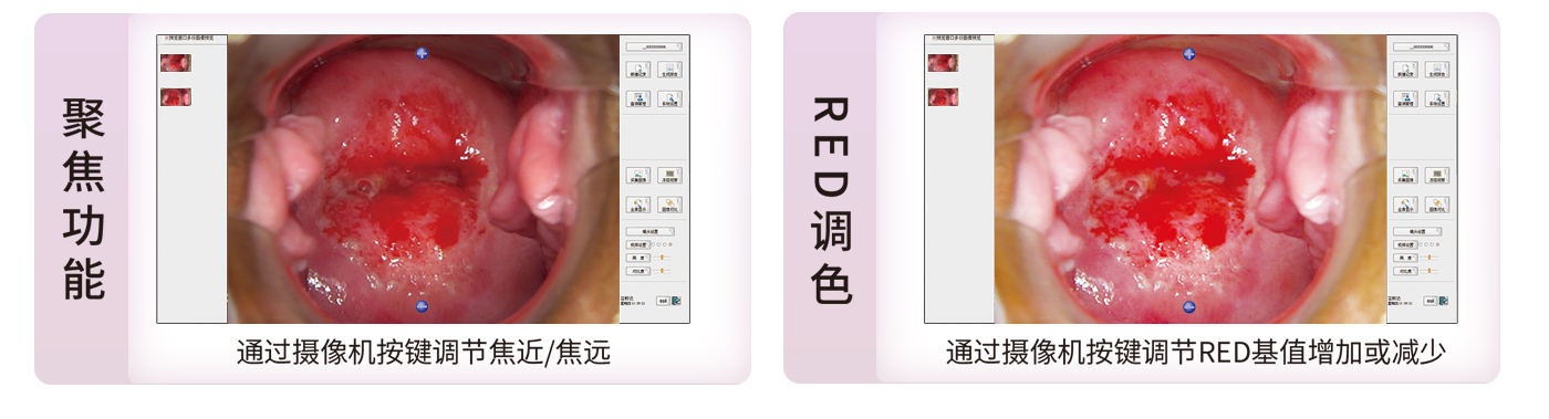 数码电子阴道镜