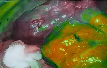 Fluorescence Fusion Imaging Mode